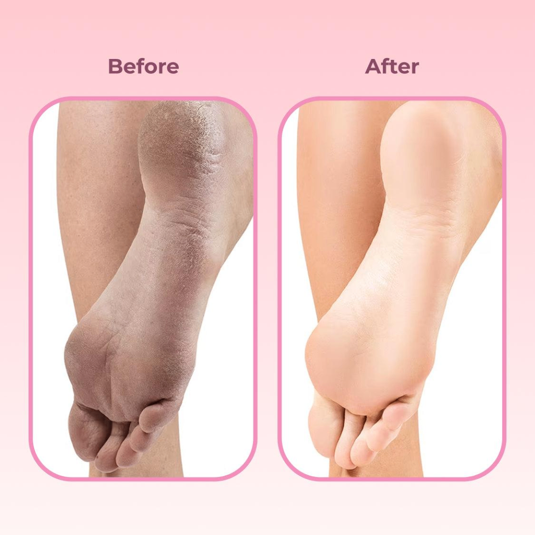 Pedix™ - Befreie Deine Füße